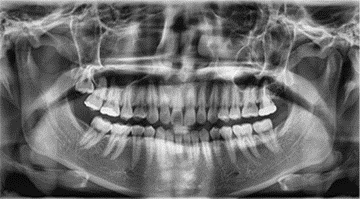 PaX-I Plus Dental machine (Pano + Rapid Ceph)